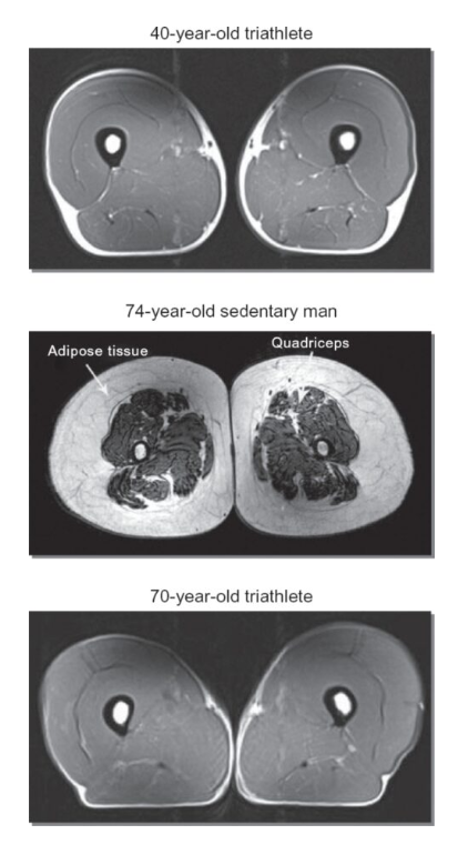 BMI quadriceps